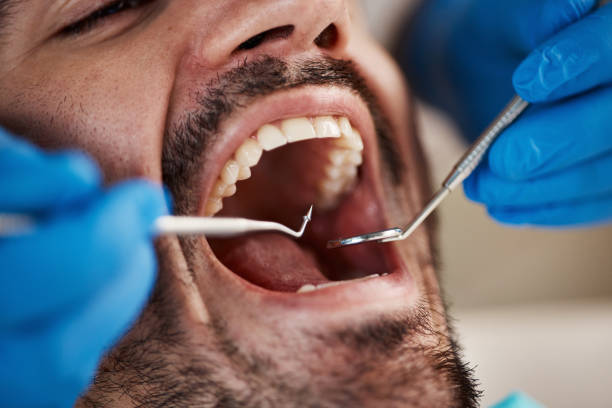 Best Emergency Wisdom Tooth Extraction in Pontiac, MI