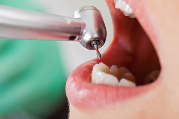 Best Broken or Chipped Tooth Repair in Pontiac, MI